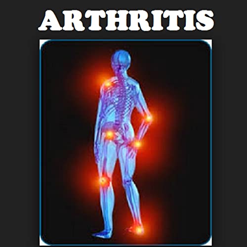 Arthritis