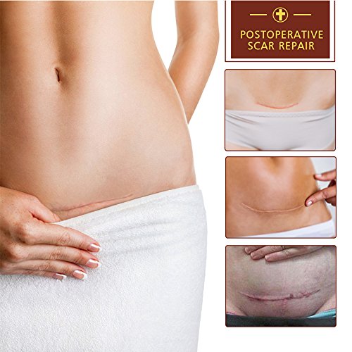 LanBeNa TCM Scar and Acne Marks Removal Cream Skin Repair Scars Burns Cuts Pregnancy Stretch Marks Acne Spots Skin Redness Treatment Cream Gel Ointment for Face and Body